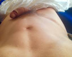 Knap geval wil prostaatje electrisch laten behandelen.mag op video.